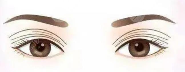 双眼皮