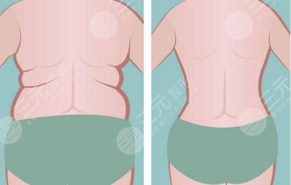 吸脂