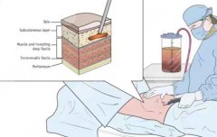 温州吸脂一般需要多少钱？温州实力派医院名单曝光！