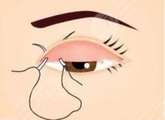 西宁第二人民医院双眼皮手术费用贵不贵？医院信息|价目表公布！