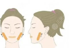 颏成型多久正常饮食？术后护理知识及注意事项分享！