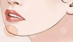 下巴发育过度颏成型整形手术有用吗？术后多久可以消肿