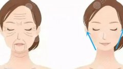 轮廓固定是什么项目？轮廓固定与面部填充有哪些区别？