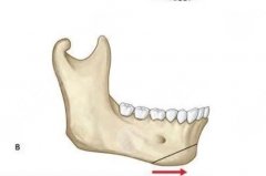 颏成型会回缩吗？手术后注意事项有哪些？