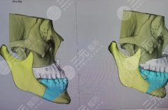 颏成型几天可以正常吃东西？除饮食之外还有哪些需要注意呢？