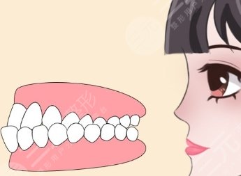 反颌矫正