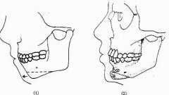 正畸正颌联合好不好？手术流程是怎么样的？