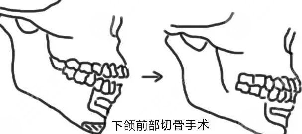 正颌手术