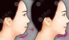 怎么让下巴变长？有什么好的方法丰下巴？区别有哪些？