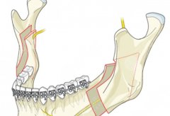 正颌手术多久可以上班？术后会不会有后遗症吗？
