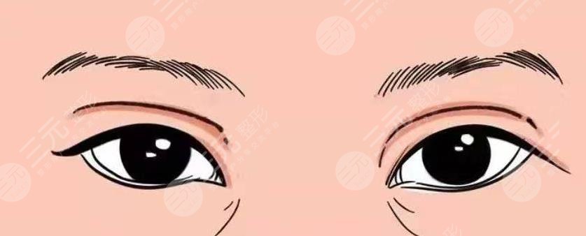 双眼皮修复
