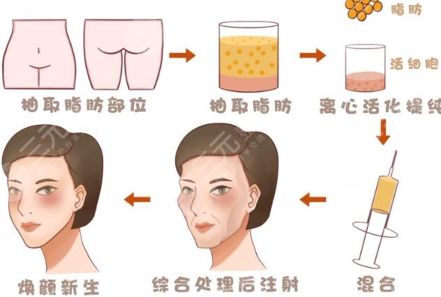 面部吸脂