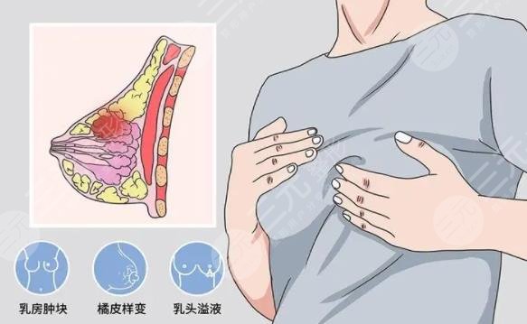 隆胸