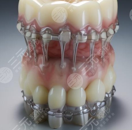 牙齿种植