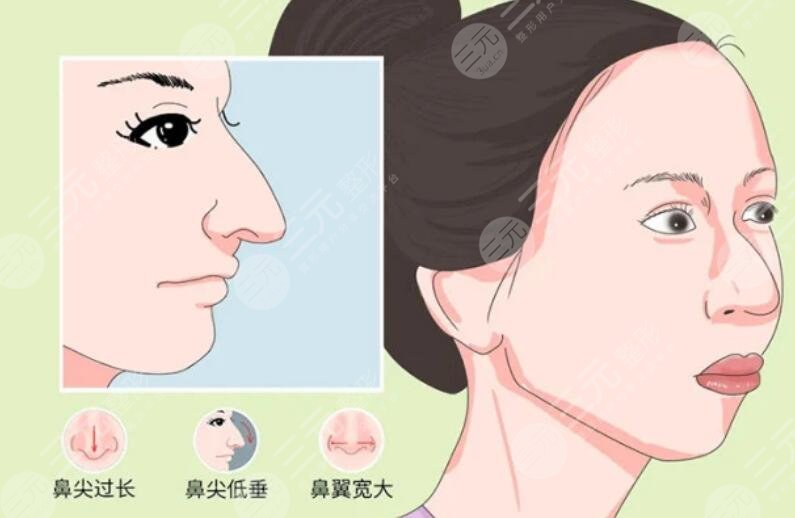 鹰钩鼻