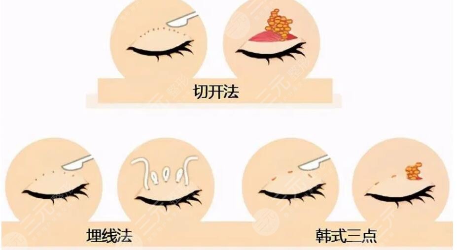 双眼皮