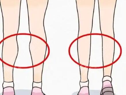 腿型矫正