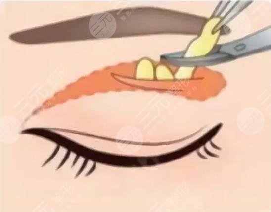 双眼皮
