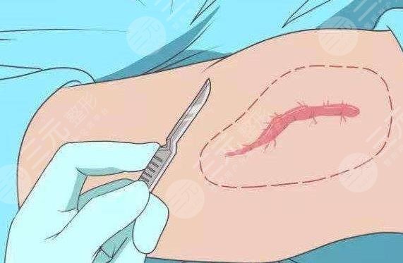 疤痕