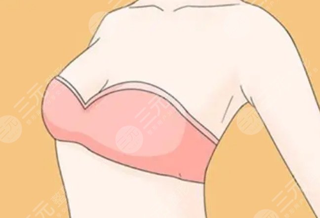隆胸
