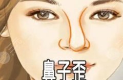 歪鼻矫正术多少钱?歪鼻矫正术是如何操作的呢? 歪鼻矫正术多少钱?歪鼻矫正术是如何操作的呢?