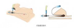 胸是假体好还是自体脂肪隆胸好？那个维持的时间更长呢？
