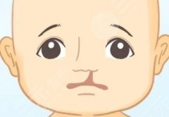 唇腭裂鼻孔一大一小修复的后还明显吗？术后如何护理呢？