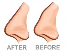 驼峰鼻整形前后对比来袭！鼻部整形手术前要注意哪些事情