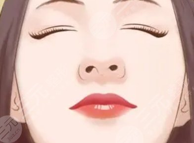 鼻翼再造