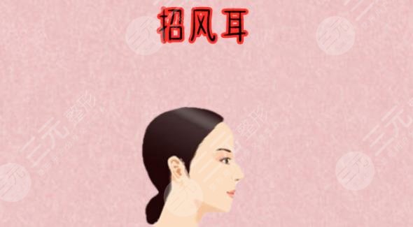 招风耳整形