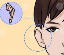 招风耳整形手术怎么做的？做手术需要住院吗？术后如何护理