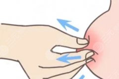 乳头内陷整形价格大概多少?手术是如何操作的?附护理注意事项 乳头内陷整形价格大概多少?手术是如何操作的?附护理注意事项