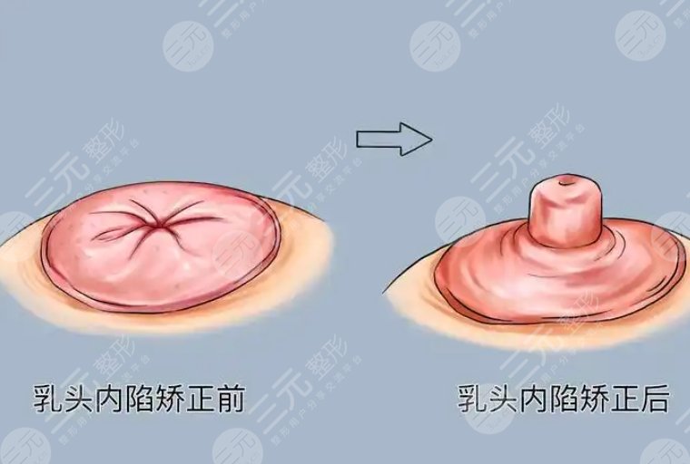 乳头内陷