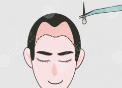 上海种发际线一般需要多少钱?含详细价格资料 上海种发际线一般需要多少钱?含详细价格资料
