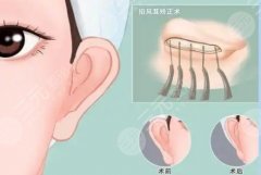 招风耳整形前后对比图分享！前后差别大不大？注意事项盘点！