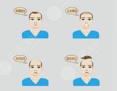 东莞种头发的价格是多少?植发价格1.2万元起 东莞种头发的价格是多少?植发价格1.2万元起