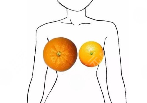 南医大深圳医院缩胸多少钱