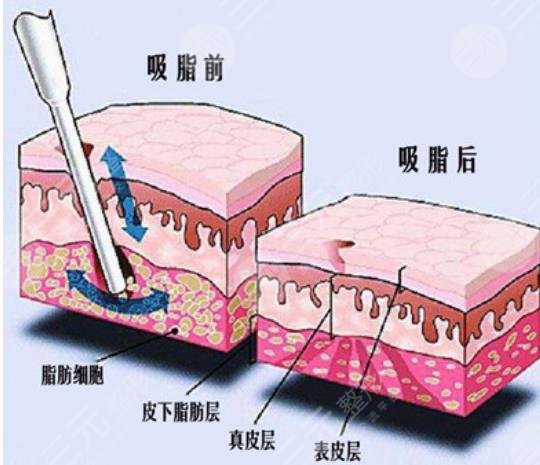 面部抽脂