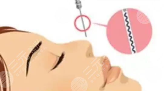 隆鼻