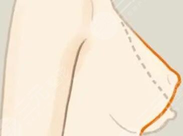 乳房悬吊