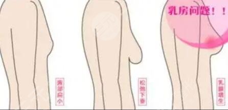 乳房悬吊