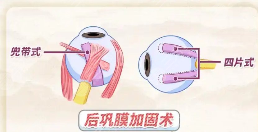 后巩膜加固术