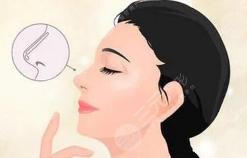 隆鼻