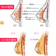 无锡隆胸专家前十名怎么样?详细名单戳进来看 无锡隆胸专家前十名怎么样?详细名单戳进来看