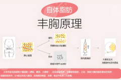 泉州隆胸医生排名哪个好?隆胸攻略和医生 泉州隆胸医生排名哪个好?隆胸攻略和医生