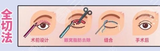 双眼皮修复