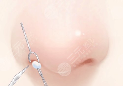 长沙华韩邓颖缩鼻翼技术可以吗