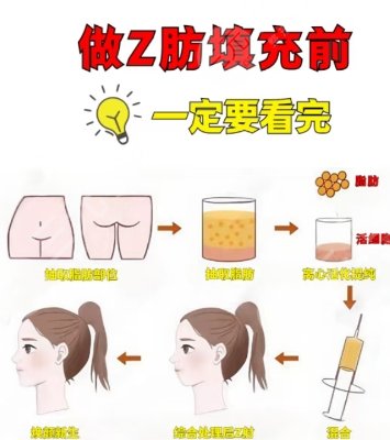 自体脂肪移植术