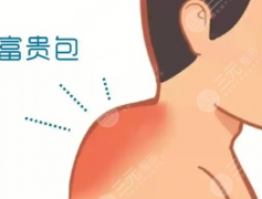 北京做富贵包手术需要住院吗？看看科普信息与医院在线分享