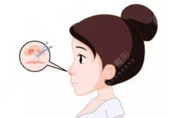 番禺区人民医院隆鼻多少钱?收费合理、实力在线!